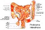 Recomandări - Colon Iritabil